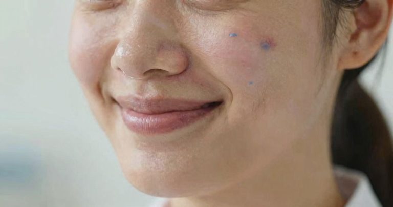 Injection d’acide hyaluronique : pourquoi un bleu se forme ?